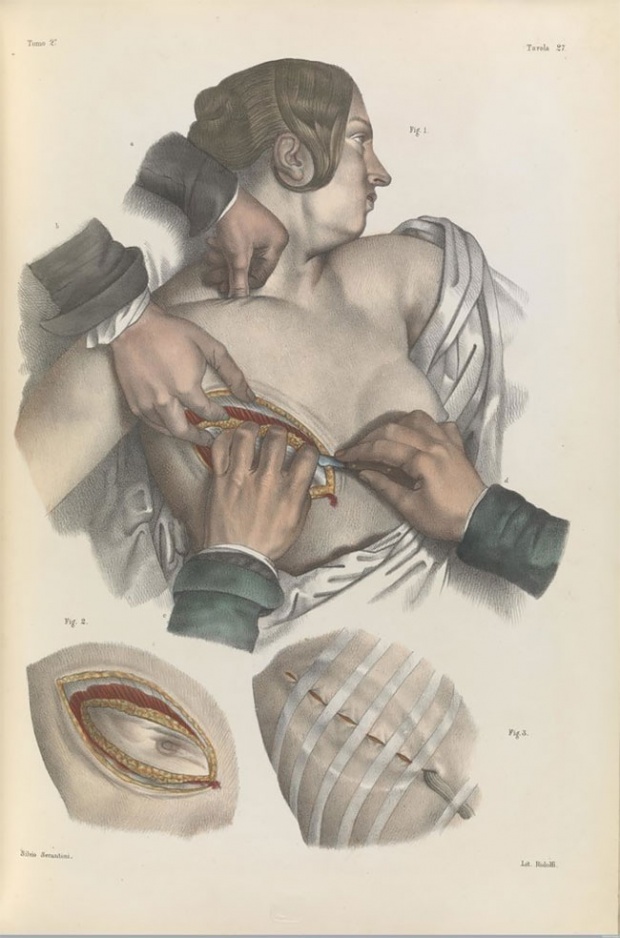 รูปภาพชวนสะพรึงของตำราแพทย์! ว่าด้วยการผ่าตัดในยุค 1830 เปี่ยมด้วยความรู้!!