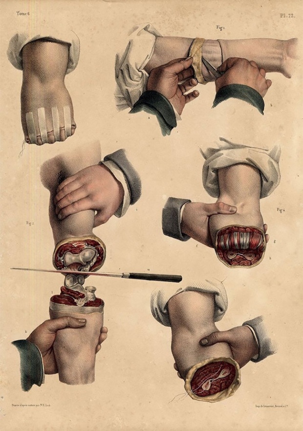 รูปภาพชวนสะพรึงของตำราแพทย์! ว่าด้วยการผ่าตัดในยุค 1830 เปี่ยมด้วยความรู้!!